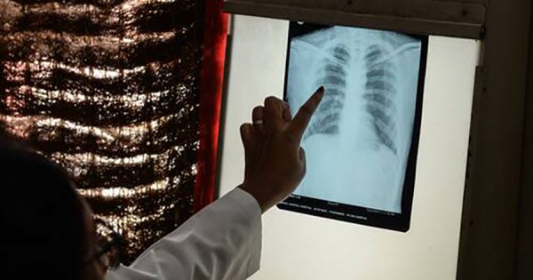 Tuberculosis deaths rise for the first time in more than a decade due to the COVID-19 pandemic