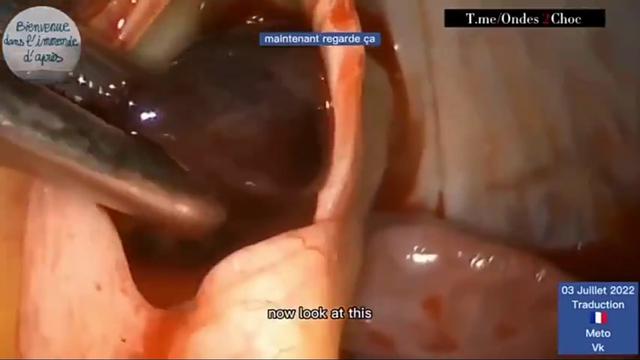 BLOT CLOT REMOVED FROM A VAXXED BEATING HEART IN SURGERY 😲
